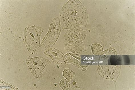 Sel Epitel Dengan Bakteri Dalam Urin Pasien Foto Stok Unduh Gambar Sekarang Kandidiasis