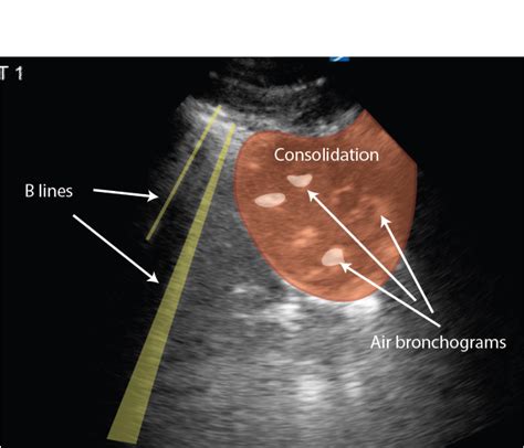 Consolidation Critical Care Sonography