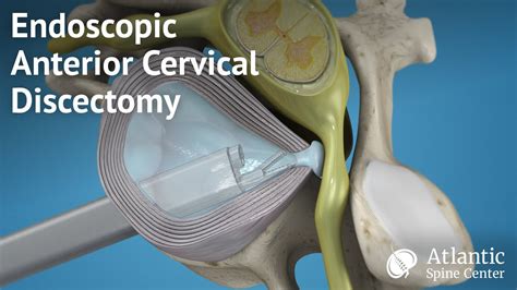 Endoscopic Anterior Cervical Discectomy Youtube