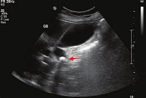 Gallstones Ultrasound