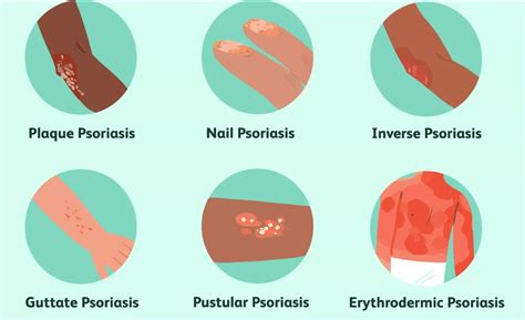 Psoriasis The Reality Of This Common Disease Of The Skin Beardy Magazine