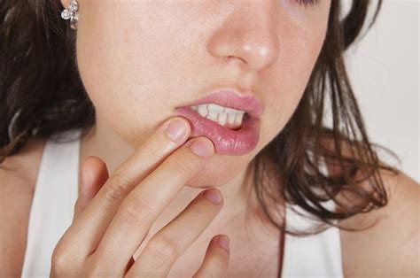 How To Treat Cold Sores When Pregnant