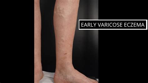 Varicose Eczema The VeinCare Centre