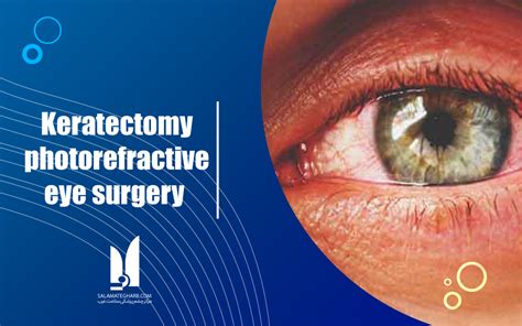 Photorefractive Keratectomy Eye Surgery