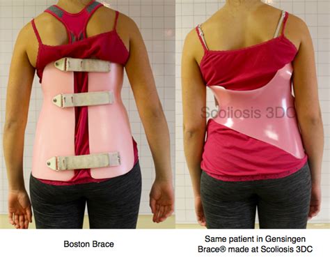 Which Scoliosis Brace Is Best Scoliosis Scoliosis Brace Scoliosis Back Brace