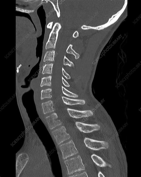 Healthy Cervical Spine Ct Scan Stock Image C0552011 Science