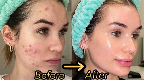 How I Finally Cleared My Acne And Textured Skin Hormonal Acne Skincare Routine YouTube