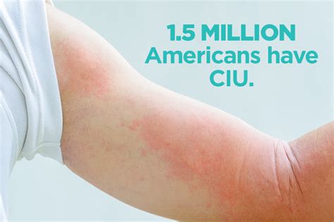 Hives That Wont Go Away The Basics Of Ciu Chronic Hives Chronic