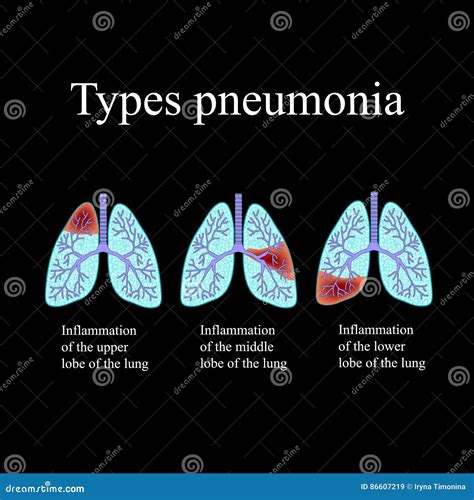 Pneumonia The Anatomical Structure Of The Human Lung Type Of