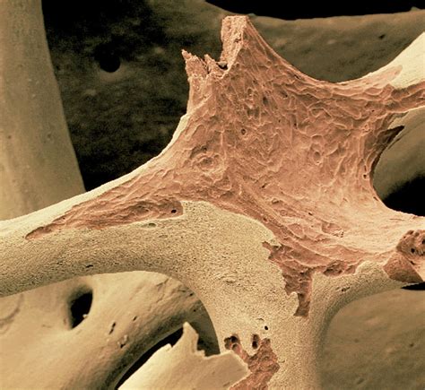 Coloured Sem Of Spongy Bone In Osteoporosis Photograph By Dr Tony Brain