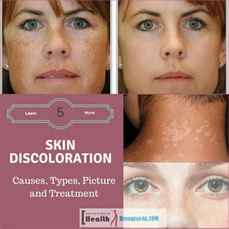 Skin Discoloration Causes Types Picture And Treatment