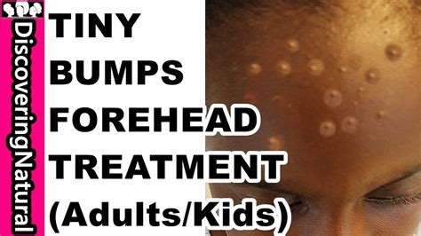 How To Get Rid Of Tiny Bumps On Forehead In 10 Days Acne Pimple