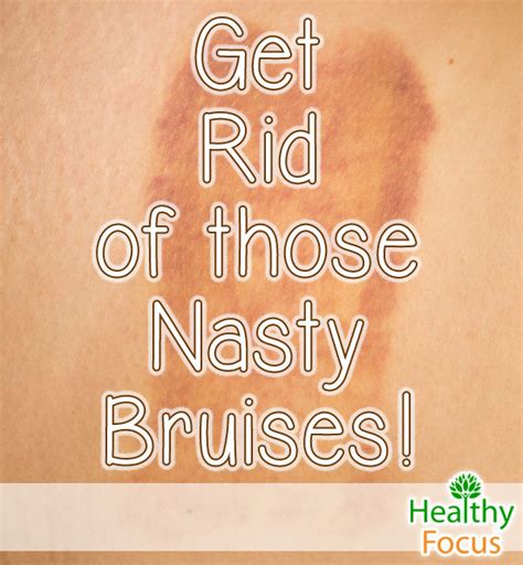 How To Get Rid Of Bruises 14 Ways Healthy Focus