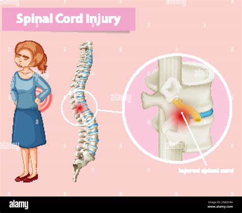 Diagram Showing Spinal Cord Injury In Human Stock Vector Image And Art