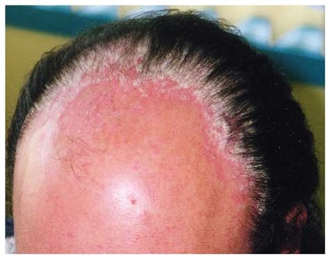 Psoriasis Hair Loss Symptoms Causes And Treatment Of Psoriatic Hair Loss