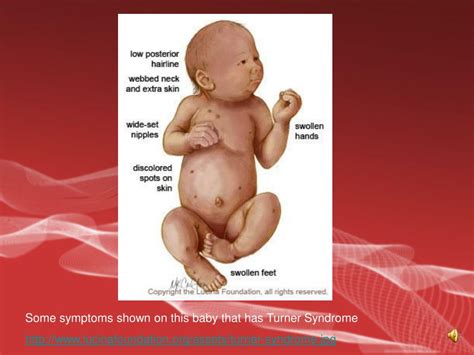Ppt Turner Syndrome Powerpoint Presentation Free Download Id4837737