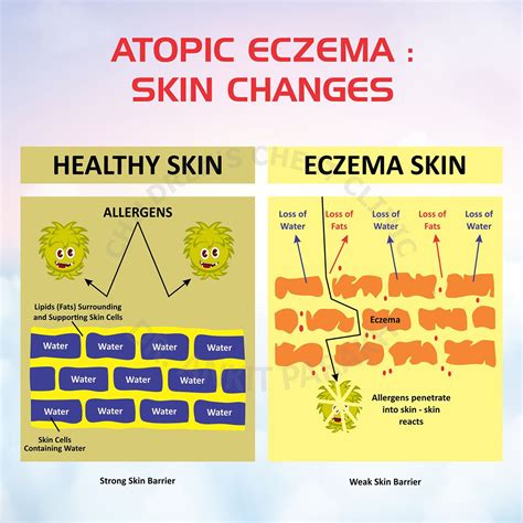 Atopic Dermatitis Eczema Dr Ankit Parakh