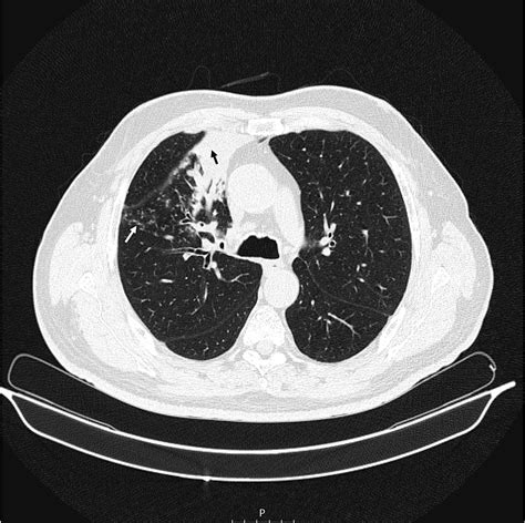 Cureus Pulmonary Actinomycosis A Diagnostic Challenge