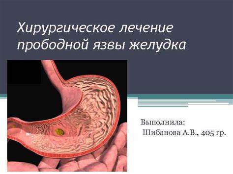 Операция прободной язвы желудка диета Хирургическое лечение прободной язвы желудка Выполнила Шибанова А Хирургическое лечение прободной язвы желудка Выполнила Шибанова А Операция прободной язвы желудка диета