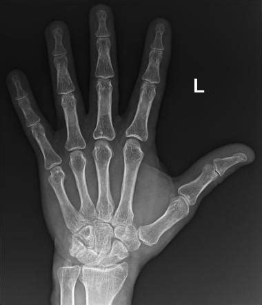 Boxer Fracture Radiology Case Radiopaedia Org