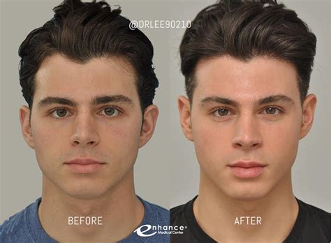 men s plastic surgery before and after fitzgibbons faruolo 99