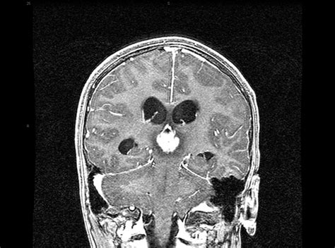 Pineal Tumor Conditions Neurooncology Specialties Ur