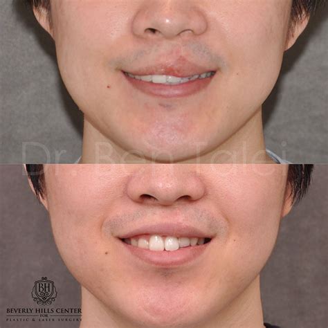 Scar Piercing And Mole Removal Before And Afters Beverly Hills Center