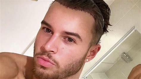 Healing Up Lovely Love Islands Alex Beattie Gives Hair Transplant