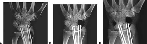 Range Of Motion Effects Of Distal Pole Scaphoid Excision And Triquetral Excision After