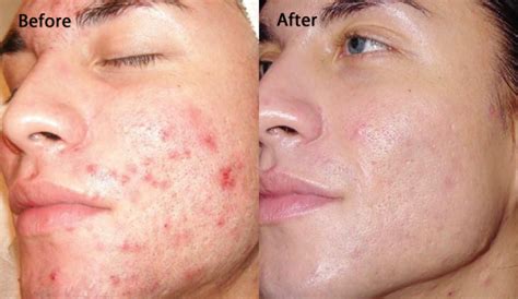 Dermabrasion And Microdermabrasion Procedures For A Renewed Healthy Skin Remedy For Acne