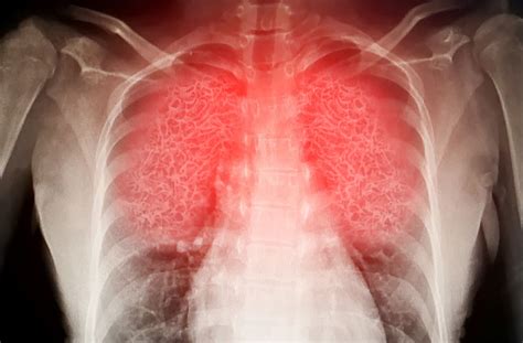Targeting White Blood Cells Responsible For Acute Lung Inflammation