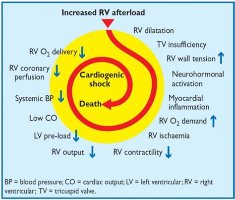 Right Heart Failure Understanding The Hemodynamics Part 4 Treating