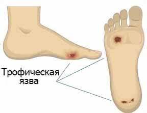 Трофические язвы лечение диета Трофические язвы на ногах: лечение, стадии и их симптомы, осложнения Трофические язвы на ногах: лечение, стадии и их симптомы, осложнения Трофические язвы лечение диета