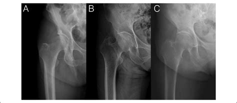 Dorr Classification Of Proximal Femur Download Scientific Diagram