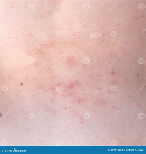 Woman With Shingles Or Herpes Zoster On Skin It Is Raised Red Bumps