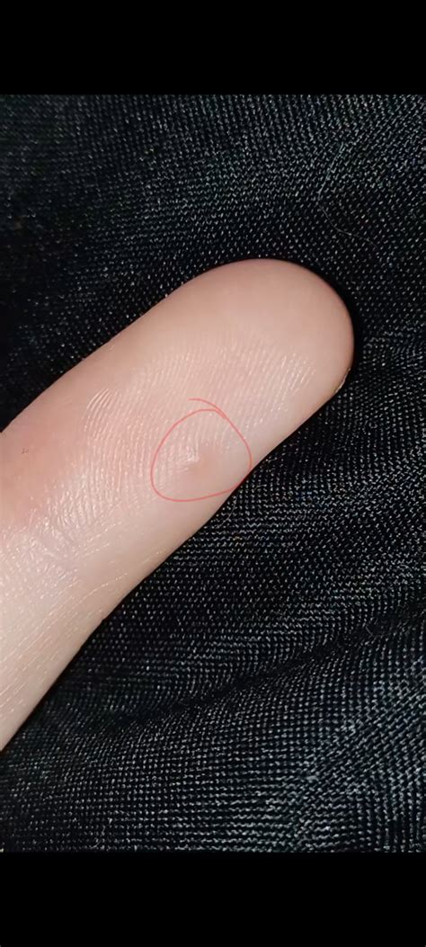 Anybody Know What This Tiny Bump On My Finger Is Its Been Around For