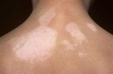 Skin Manifestations Of Thyroid Disorders A Review