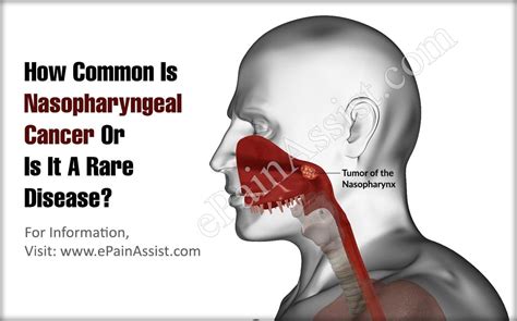 Nasopharynx Cancer Anatomy And Images