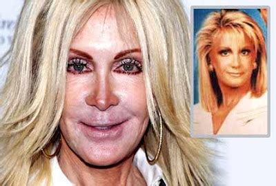 Joan Van Ark Plastic Surgery Before And After Nose Job Facelift And Cheek Implants Plastic