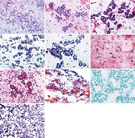 Cytologic Features Of Follicular Adenoma Fa A Low Power View Of