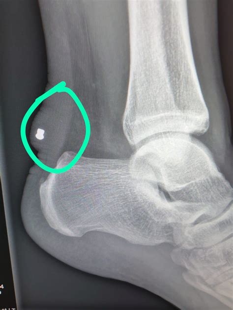 My Friend Has Had This Lump In His Ankle After An Xray We Think Its A