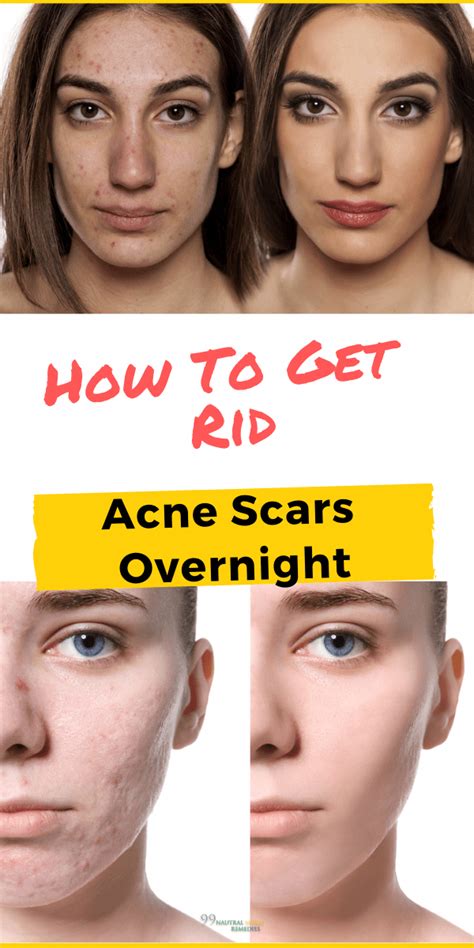 How To Get Rid Of Acne Scars Naturally Fast Shearlingwomenbestquality