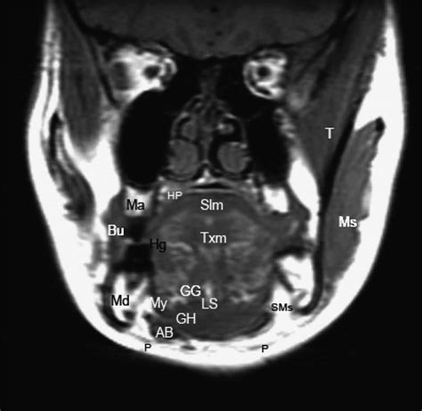 Coronal T1 Mri Of Normal Oral Cavity Anatomy Ab Indicates Anterior