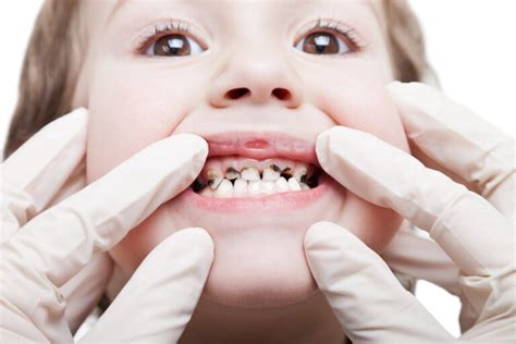 Childrens Removable Braces Kensington Moira Wong Orthodontics