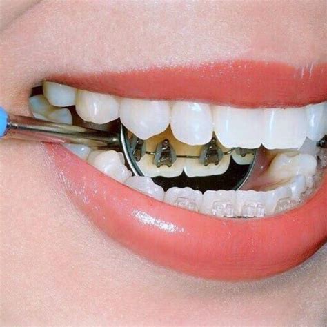 Lingual Braces Moody And Trussville Brooks Orthodontics