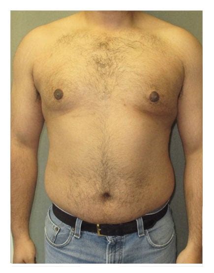 Gynaecomastia London Get Costs Before And Afters And Recovery Info