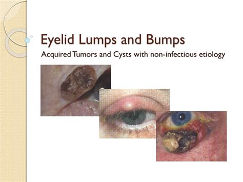 Ppt Eyelid Lumps And Bumps Powerpoint Presentation Free Download