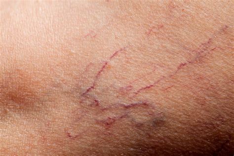 How To Erase And Prevent Broken Capillaries The Healthy