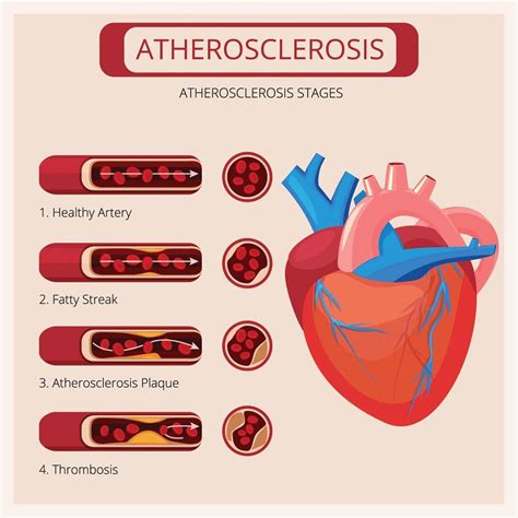 Presentation Cardiovascular Disease Causes And Prevention Official