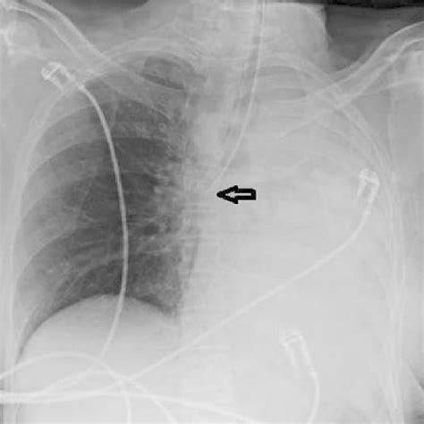 Chest X Ray Showing Malpositioned Intercostal Drainage Tube In A Case